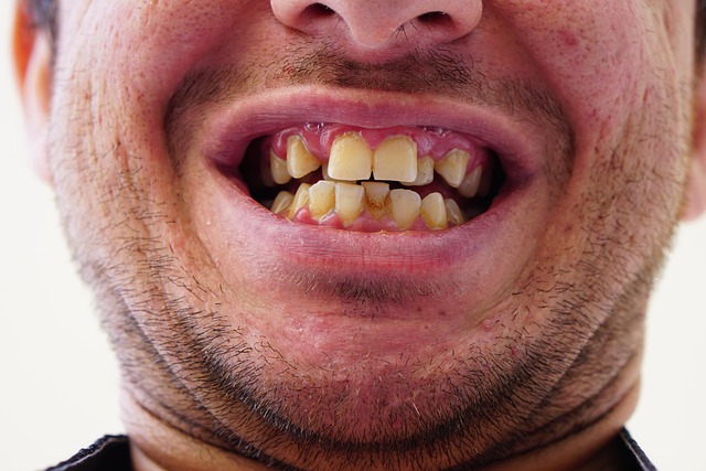 Derfor vælger flere københavnere invisalign frem for bøjle